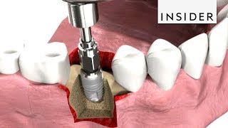 How Dentists Insert Dental Implants [upl. by Ffilc]