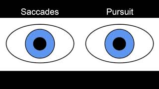 Case Challenge The patient had hypermetric saccades Video 1 [upl. by Ayrb]