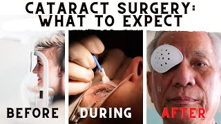 Cataract Surgery Patient Experiences [upl. by Ivad]