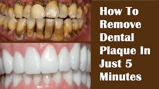 Tartar  Plaque And Calculus Removal From Lower Front Teeth  Dental Scaling On Lower Teeth  Part1 [upl. by Haveman]