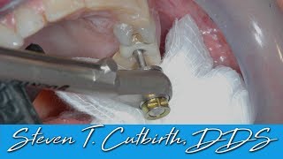 Loose Implant Screw  Dental Minute with Steven T Cutbirth DDS [upl. by Nolyaw750]