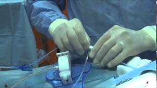 Coronariografía y Angioplastia con Stents 1mov [upl. by Brottman]