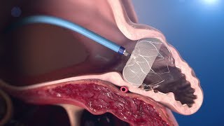 WATCHMAN Implantation Technique [upl. by Torrell]