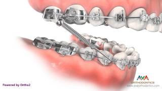 Orthodontic Treatment for Overjet Overbite  Forsus Appliance [upl. by Ameer]