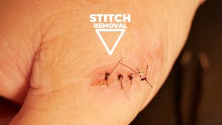 Suture Removal StepbyStep Guide [upl. by Hasty735]