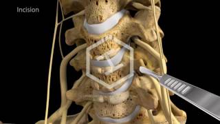 c5c6c7 Anterior Cervical Discectomy with Fusion [upl. by Berhley]