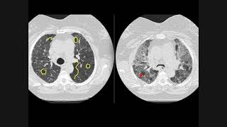 Hypersensitivity pneumonitis how to recognise on chest CT scans [upl. by Viv554]