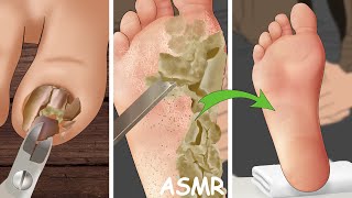 ASMR Ingrown Toenail Removal Treatment Animation  WOW Brain Deep Clean Treatment [upl. by Tteve230]