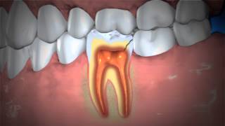 Treatment of Abscessed Teeth [upl. by Anurb67]