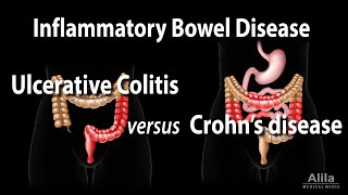 Ulcerative Colitis Clinical Remission  The Role of Cabbage Juice [upl. by Ronnholm]