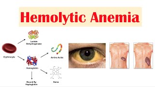 Hemolytic Anemia [upl. by Aohk]