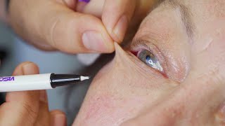 Eyelid Cyst Removal via Punch Technique with closure at Las Vegas Dermatology [upl. by Lebbie]