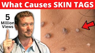 What SKIN TAGS Really Mean What Causes Skin Tags [upl. by Noillid]