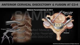 Anterior Cervical Discectomy amp Fusion at C34 [upl. by Susanetta]