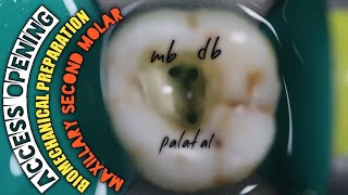 Access Opening in Maxillary Second Molar Biomechanical Preparation  Protaper Rotary Endodontics [upl. by Justinn]