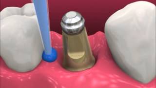 Smyl Manatee  Dental Implant Procedure [upl. by Maccarone]