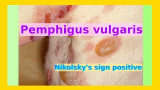 pemphigus vulgaris [upl. by Ummersen]