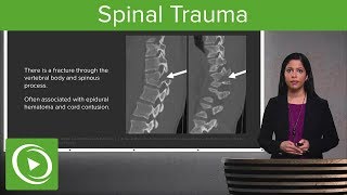 Spinal Trauma Cervical Trauma Protocol Common Spinal Fractures – Radiology  Lecturio [upl. by Vastha255]