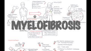 Primary Myelofibrosis  Overview presentation pathophysiology investigation treatment [upl. by Evreh]