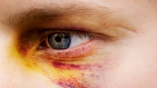 How to Get Rid of a Black Eye Fast  Black Eye Treatment [upl. by Lisandra]