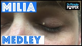 A Dr Pimple Popper Milia Medley [upl. by Kcirdnek911]