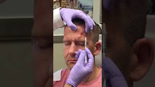 I almost RUINED my face  Botox Masseter [upl. by Lachish909]