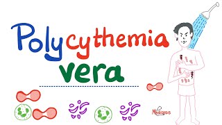 Polycythemia Vera PV  Myeloproliferative Neoplasm MPN  Erythrocytosis  Hematology [upl. by Alanna]