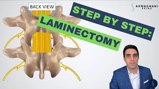 Step by step how to perform a lumbar laminectomy [upl. by Omik]