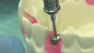 Placing Implant Abutments [upl. by Haddad]