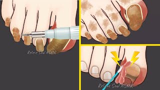 💟 ASMR ☮️ INGROWN Toenail Removal Treatment Animation [upl. by Sunshine]