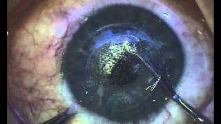 Conjunctiva Concretion Removal in 10 seconds [upl. by Kleon]