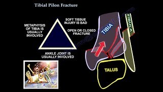 Tibial Pilon Fracture  Everything You Need To Know  Dr Nabil Ebraheim [upl. by Edijabab]