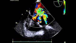 AORTIC DISSECTION ECHOCARDIOGRAPHY [upl. by Aneekan294]