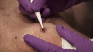 Watch amp Learn Electrosurgery [upl. by Nedrah]