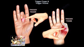 Trigger Finger amp Trigger Thumb  Everything You Need To Know  Dr Nabil Ebraheim [upl. by Litta]