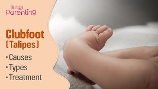 Club Foot Talipes in Babies  Causes Signs amp Treatment [upl. by Sansbury218]