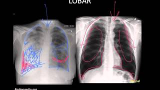 Pneumonia Imaging [upl. by Annibo]