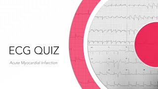 ECG Quiz Acute Myocardial Infarction [upl. by Gleda304]