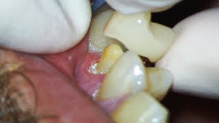 Dental Crown EXPLAINED and how much Tooth Youll Lose [upl. by Adnaluy588]