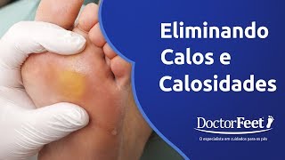 Eliminando calos e calosidades [upl. by Innoc]