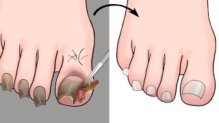 ASMR Ingrown Toenail Removal Treatment Animation  ENJO Relaxing [upl. by Ycram]