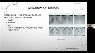 Pneumocystis jirovecii pneumonia  Current Issues in its Management [upl. by Etaner832]