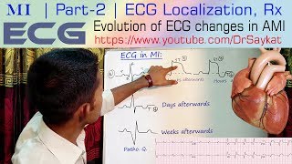 MI  Part 2  ECG Localization amp Treatment of Myocardial Infarction  Dr Saykat [upl. by Jaal]