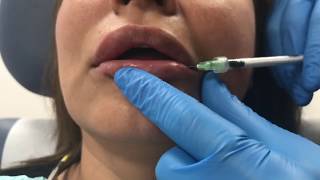 Reversing poorly placed lip filler using Hylenex hyaluronidase [upl. by Barnabe]