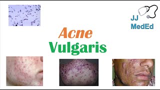 Acne Vulgaris  Causes Pathogenesis Influencing Factors Diagnosis Treatment and Complications [upl. by Demetris]