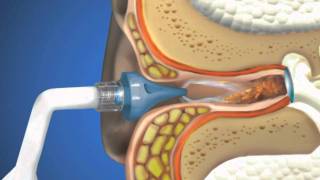 Bionix® OtoClear® Ear Irrigation [upl. by Adrell182]