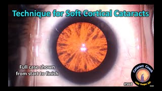 What is Secondary Cataract amp is it seriousDr Dipali Prabhu [upl. by Mcintosh]