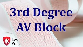 3rd Degree AV Block ECG  EMTprepcom [upl. by Andonis]