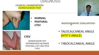 Congenital Talipes Equino Varus CTEV  Rapid Revision of Orthopaedics by Dr Prateek Joshi [upl. by Naimerej]