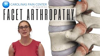 Natalie Explains Facet Arthropathy [upl. by Feodore905]